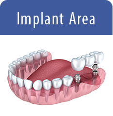 Dental bridges illustration