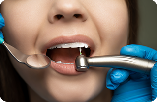 Root canal treatment illustration